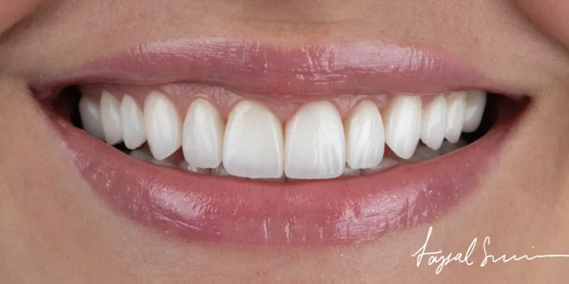 The Veneers Consultation Questions You Must Ask