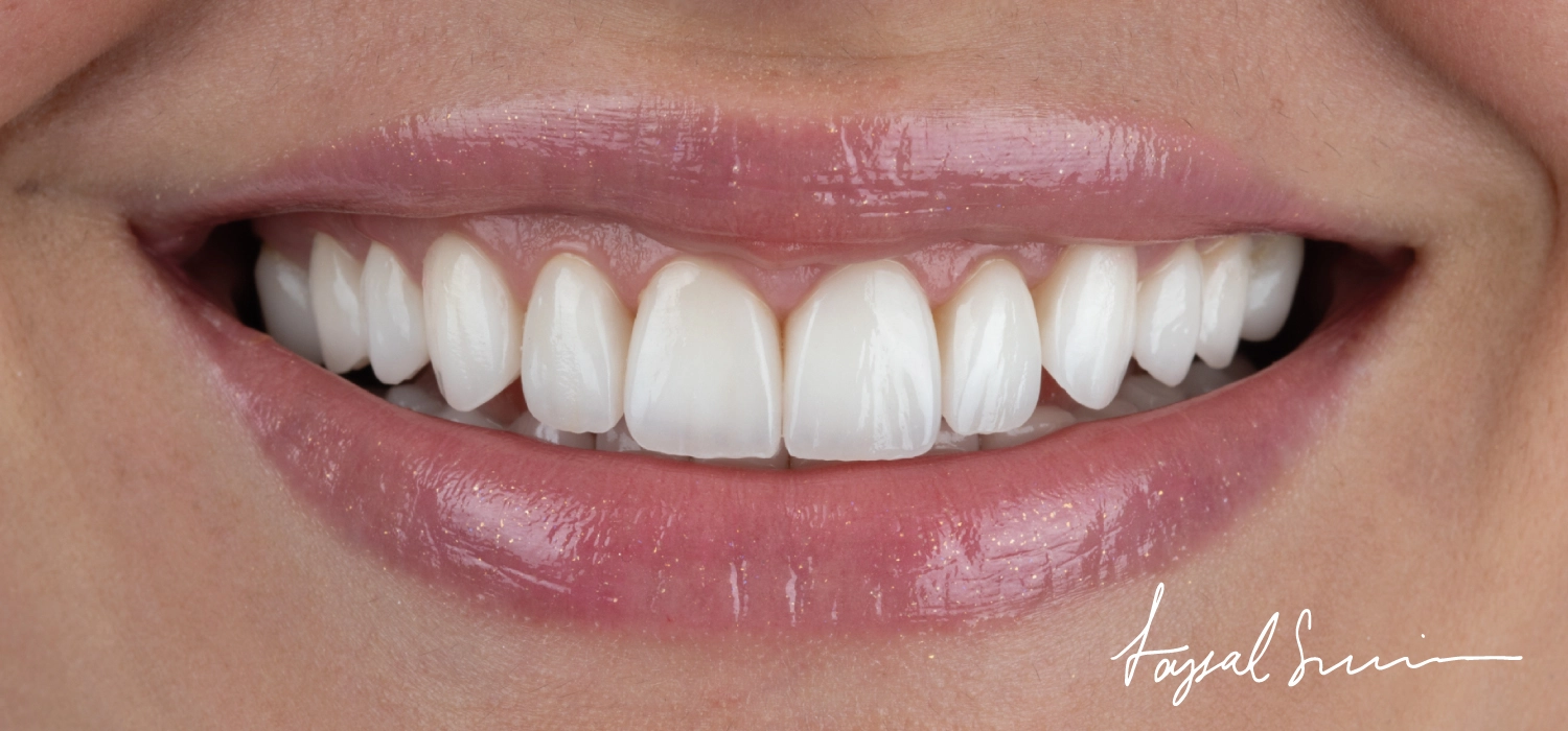 The Veneers Consultation Questions You Must Ask